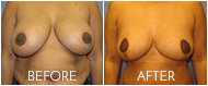 Breast Reduction Before and After CT